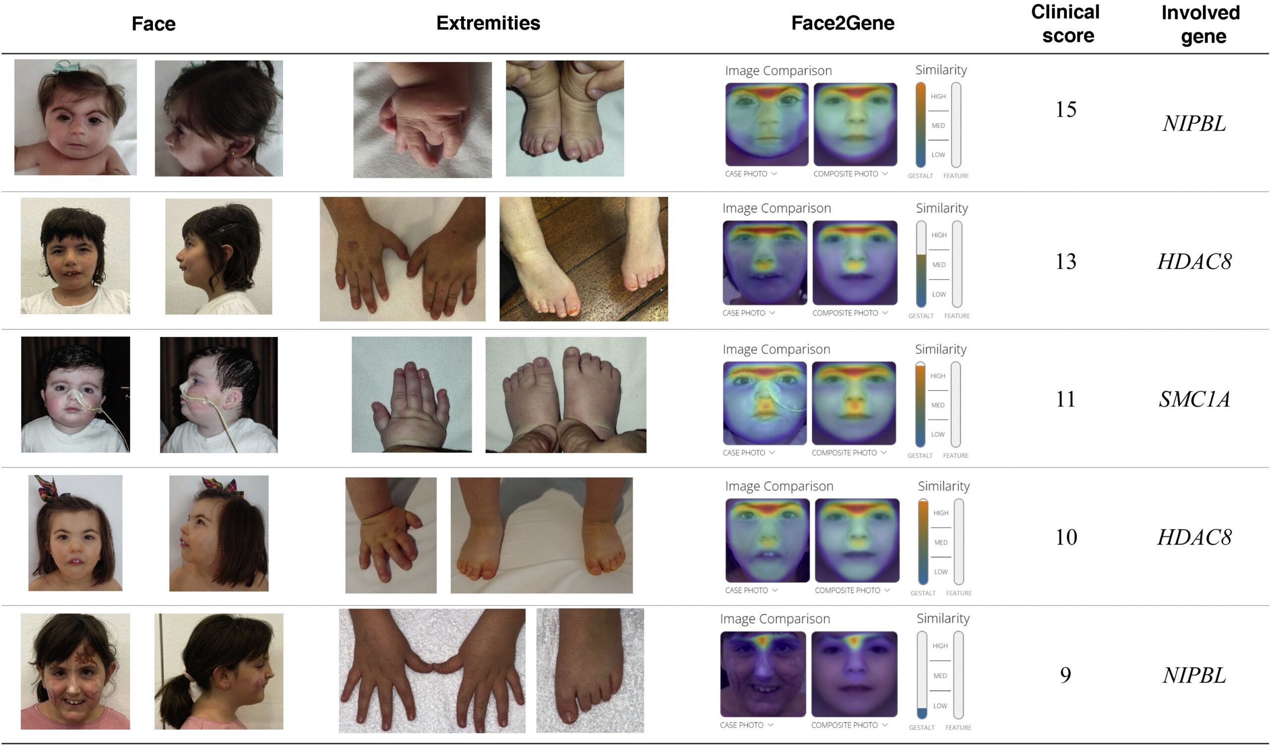 Cornelia De Lange Spectrum Anales De Pediatr A