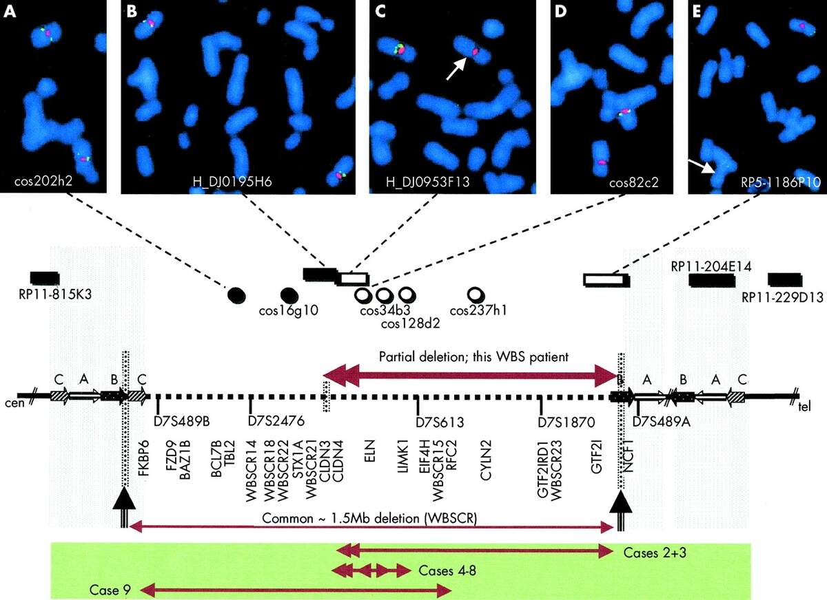 Partial Deletion Of The Critical 1 5 Mb Interval In Williams Beuren Syndrome Journal Of Medical Genetics